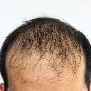 vecteezy_close-up-of-asian-male-pattern-baldness_6877362